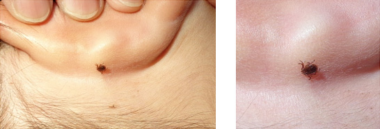 子どもの耳の後ろにくっついているマダニ